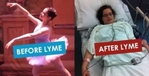 Lyme before after pic